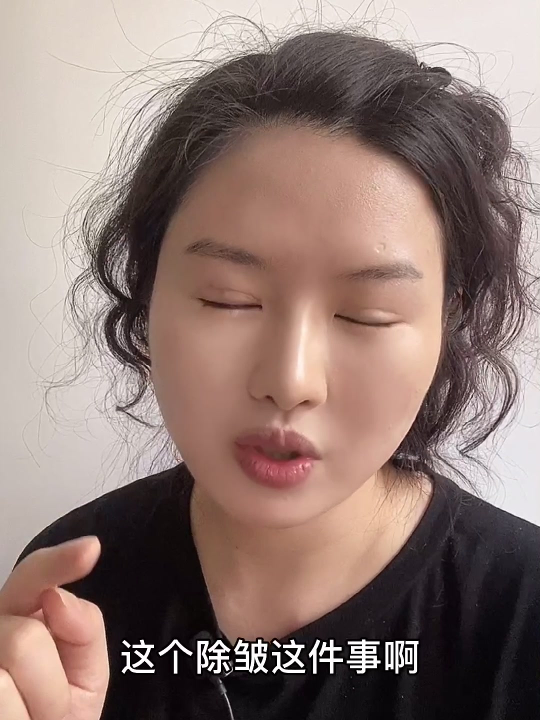 打肉毒素除皱一周后效果对比,并分析利弊