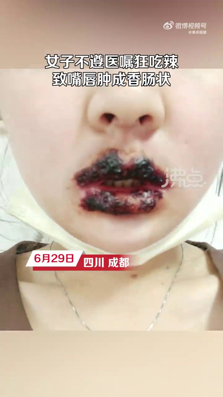 「女子嘴巴过敏仍狂吃辣嘴肿成烤肠 当事人:想以毒攻毒」6月29日,四川成都,女子早期嘴巴过