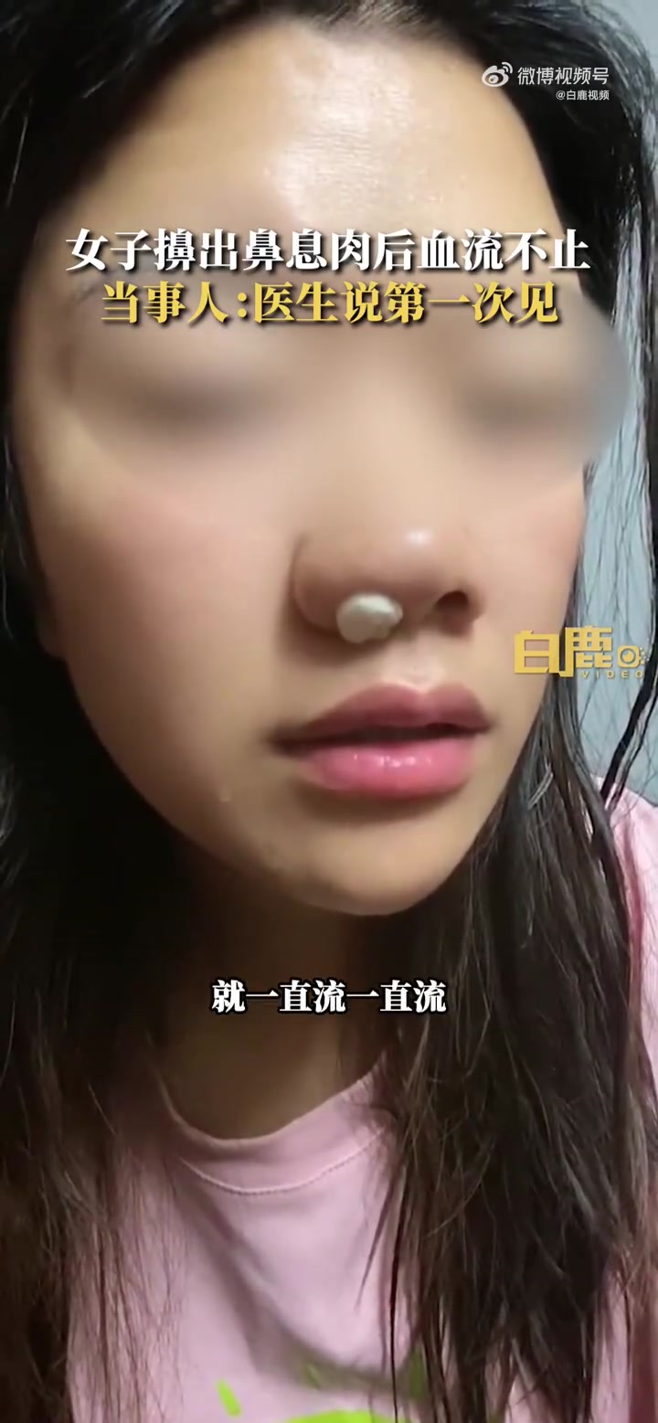 「女子擤鼻涕擤出息肉血流不止 当事人:医生说第一次见」7月6日,江苏徐州。钱女士起床上班,