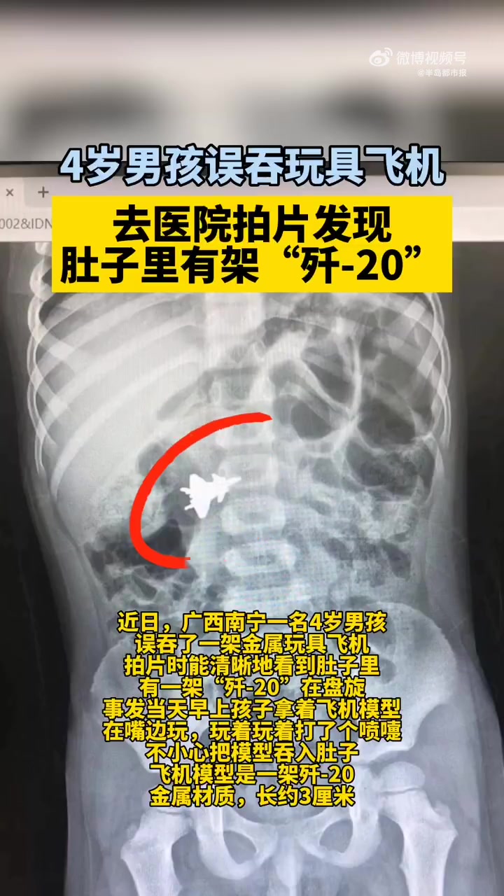「4岁男孩就诊发现肚子里有架歼20」近日,广西南宁,4岁男孩误吞一架“歼-20”金属玩具飞