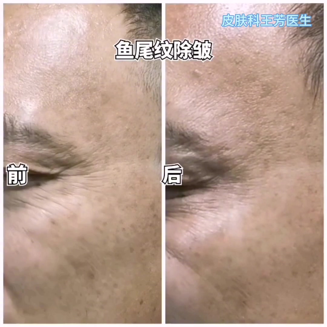 肉毒素除皱动态对比视频