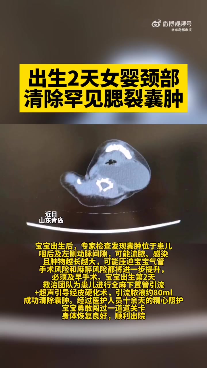 「出生2天女婴颈部清除罕见腮裂囊肿」近日,青岛妇儿医院为一位出生仅2天的女婴颈部清除了腮裂