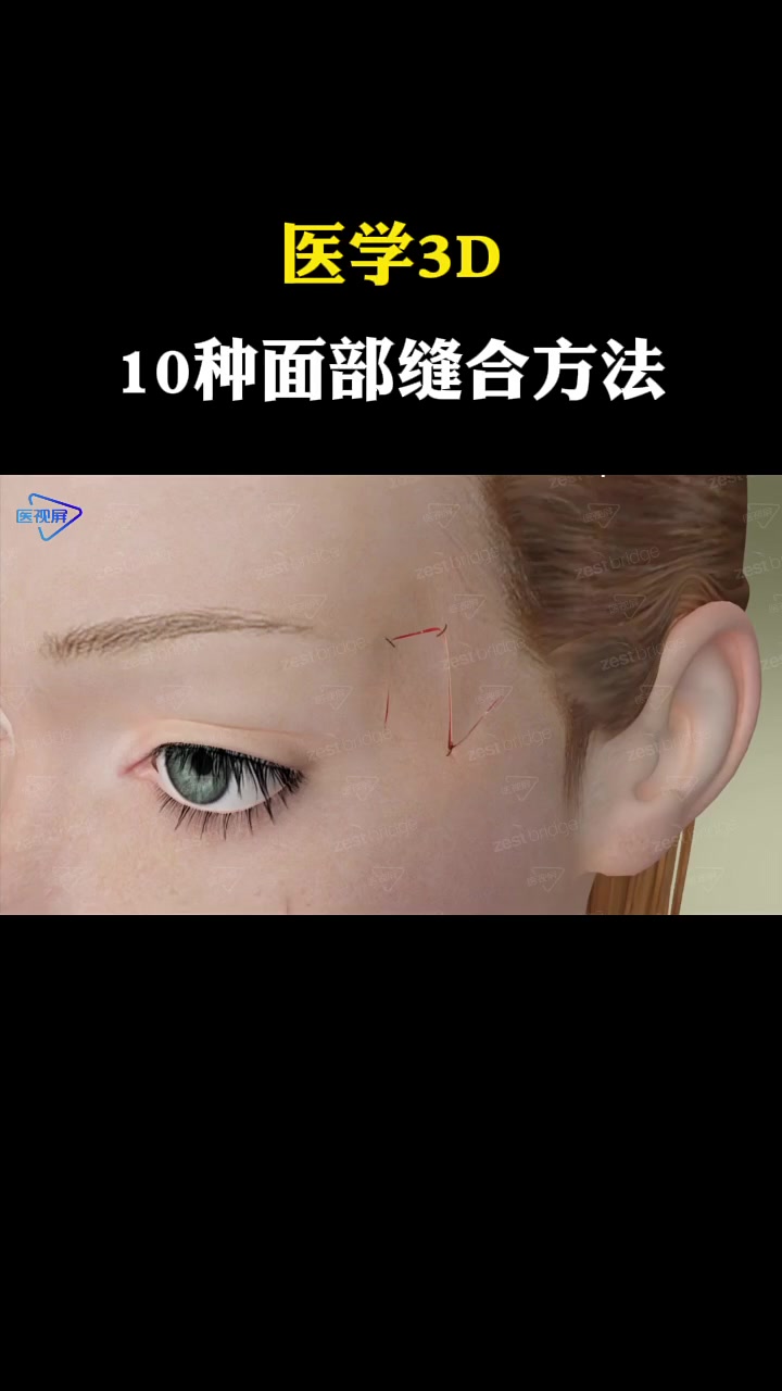 「医学3D」10种面部伤口处理方法,看看哪种疤痕最小?