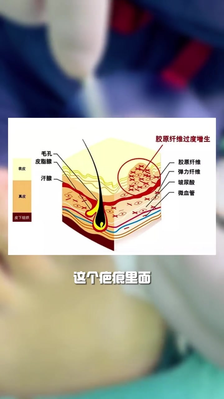 温暖潮的马靴里面,发炎的脚指头正悄咪咪地露出了头 嵌甲 甲沟炎 指甲修复的方法 华东医院陈