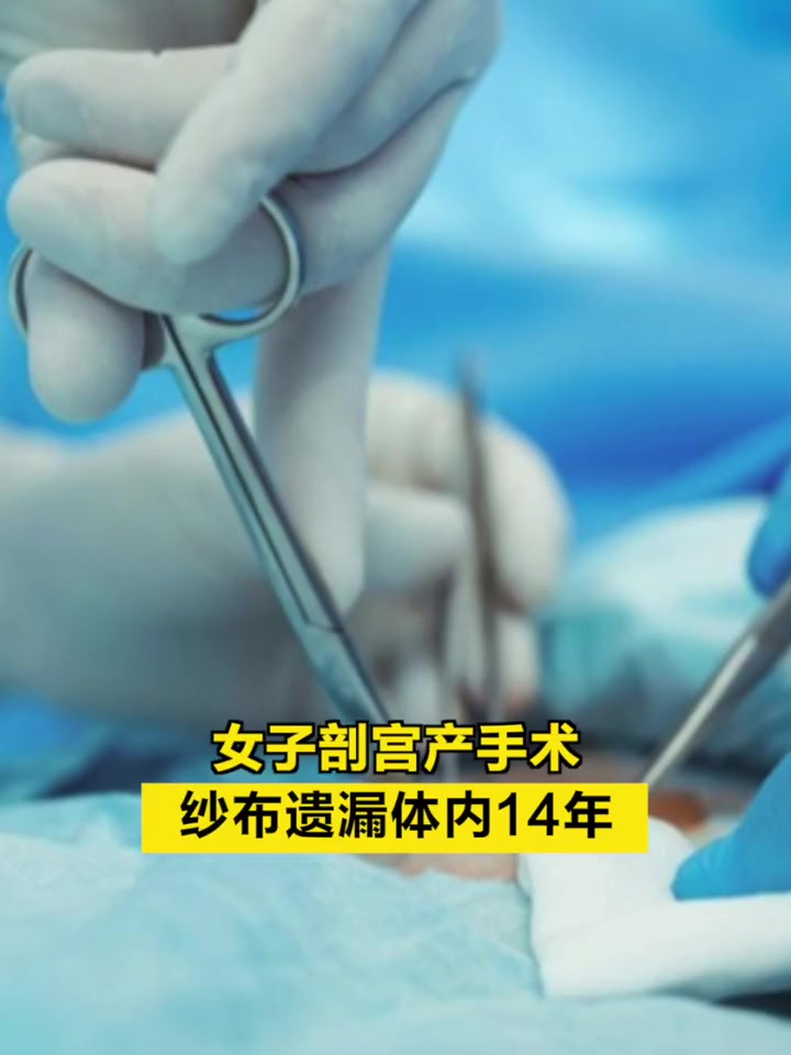 「女子剖宫产手术纱布遗漏体内14年」8月31日,湖南娄底。新化县的伍女士反映,其14年前做