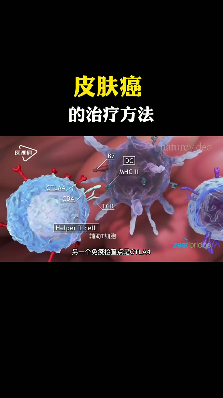 皮肤癌的治疗包括免疫治疗—刺激免疫系统以攻击癌细胞,放射治疗——使用放射帮助摧毁癌细胞,靶