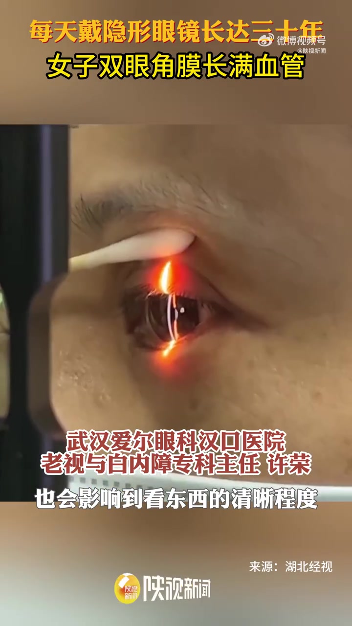 「女子戴隐形30年双眼角膜长满血管」近日湖北武汉,彭女士出现严重的红眼、怕光、流泪,检查后