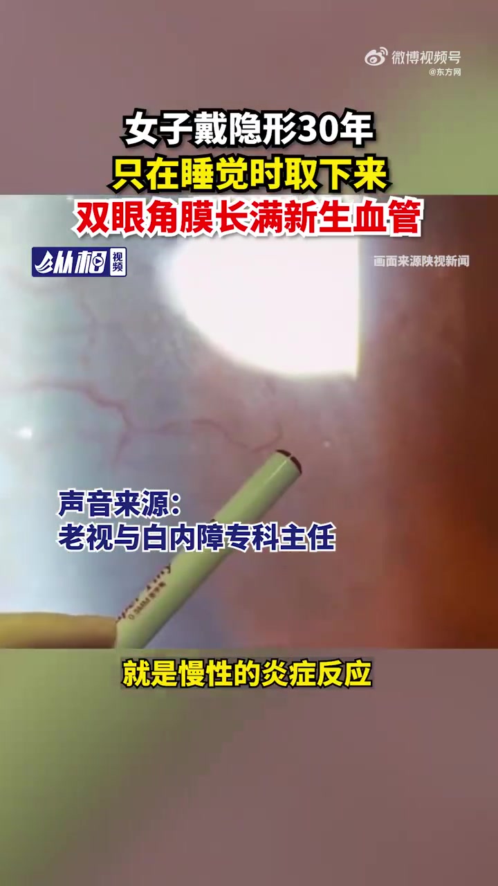「女子戴隐形眼镜30年,只在睡觉时取下来,双眼角膜长满新生血管」据陕视新闻9月17日报道,