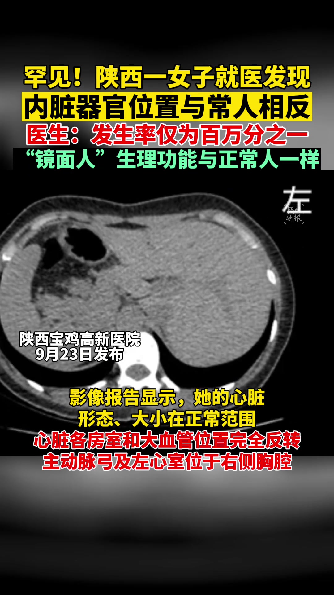 近日,张女士(化名)在宝鸡高新医院就诊检查过程中发现:她的肝脏、脾脏、胆囊等内脏器官的位置