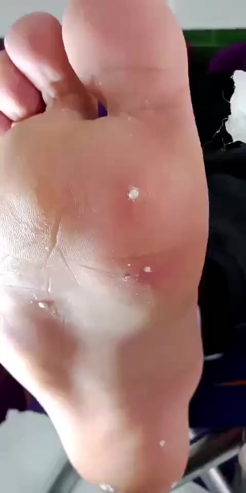 跖疣就这样擦一擦