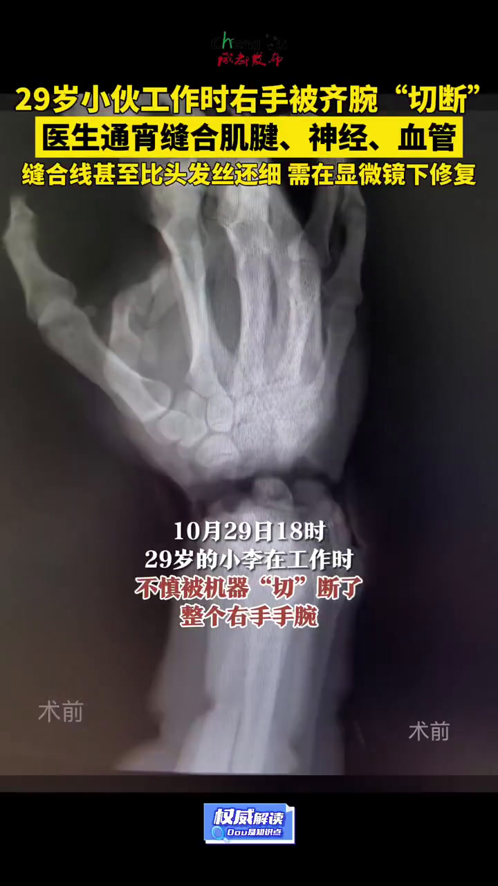「右手保住了!29岁小伙手腕被切断医生通宵缝合」10月29日下午6点,29岁的小李在工作时