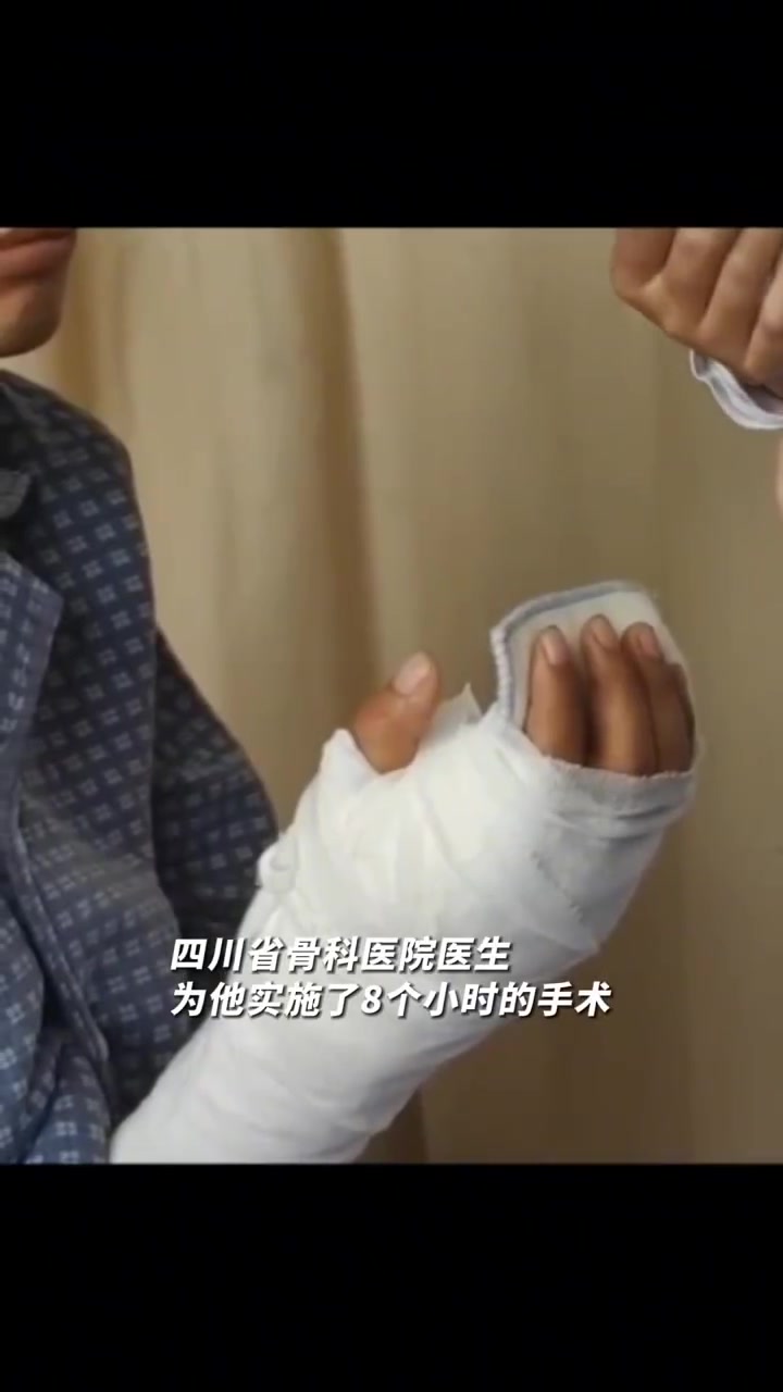 「神乎其技!医生显微镜下手术为男子接回断腕」近日,四川成都,29岁的李先生在工作时右手手腕