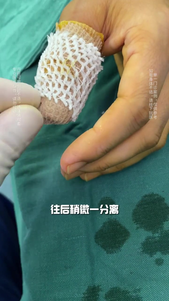 翼状胬肉,有人知道吗?甲沟炎 科普 华东医院陈亮