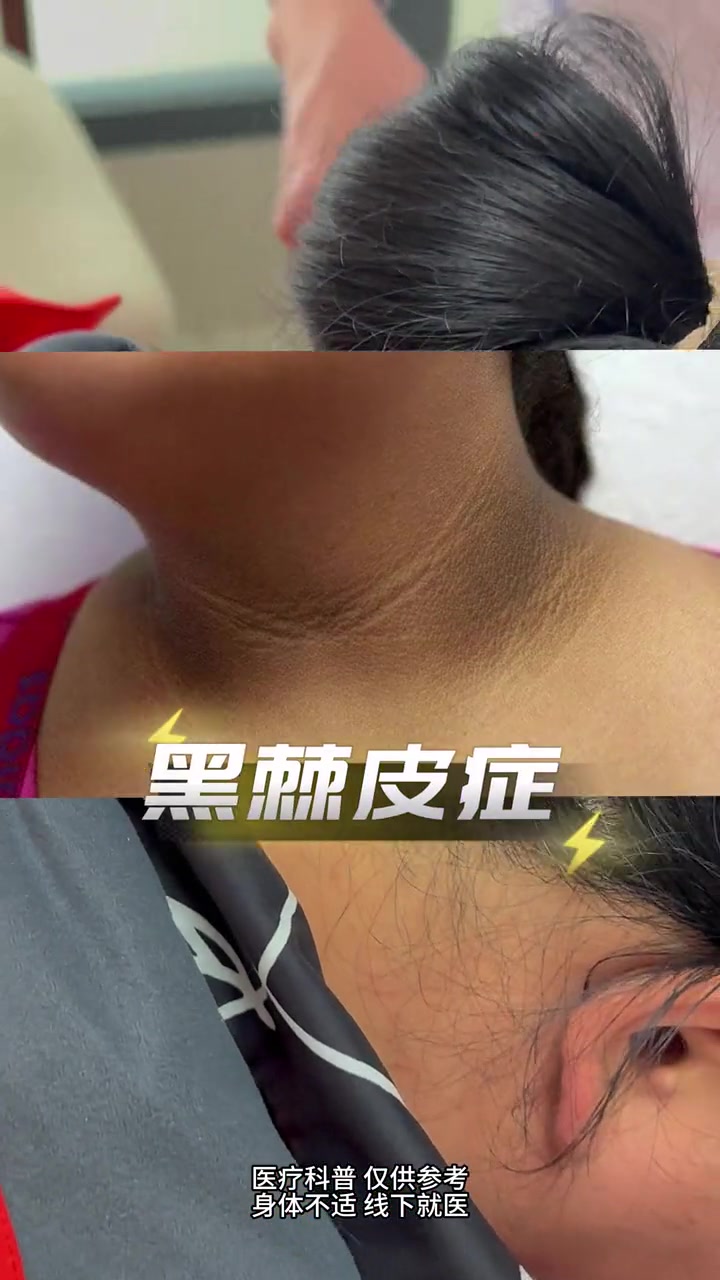 洗澡洗不干净的黑脖子病,是什么东西?脖子黑是糖尿病前期表现,请大家重视起来 减重吴边主任 