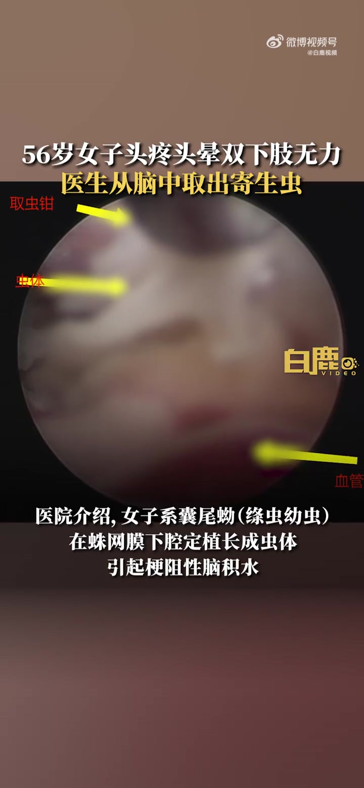 「56岁女子头疼查出脑内感染猪带绦虫 医生:生熟案板分开,猪肉熟吃」近日,陕西西安。一56
