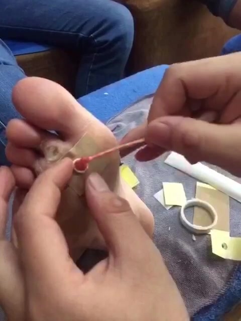 教学封包鸡眼瘊子