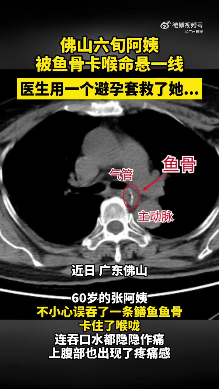 「果真有一套!医生用避孕套成功取出卡喉鱼骨」近日,佛山丹灶60岁张阿姨一不小心误吞了一条鳝