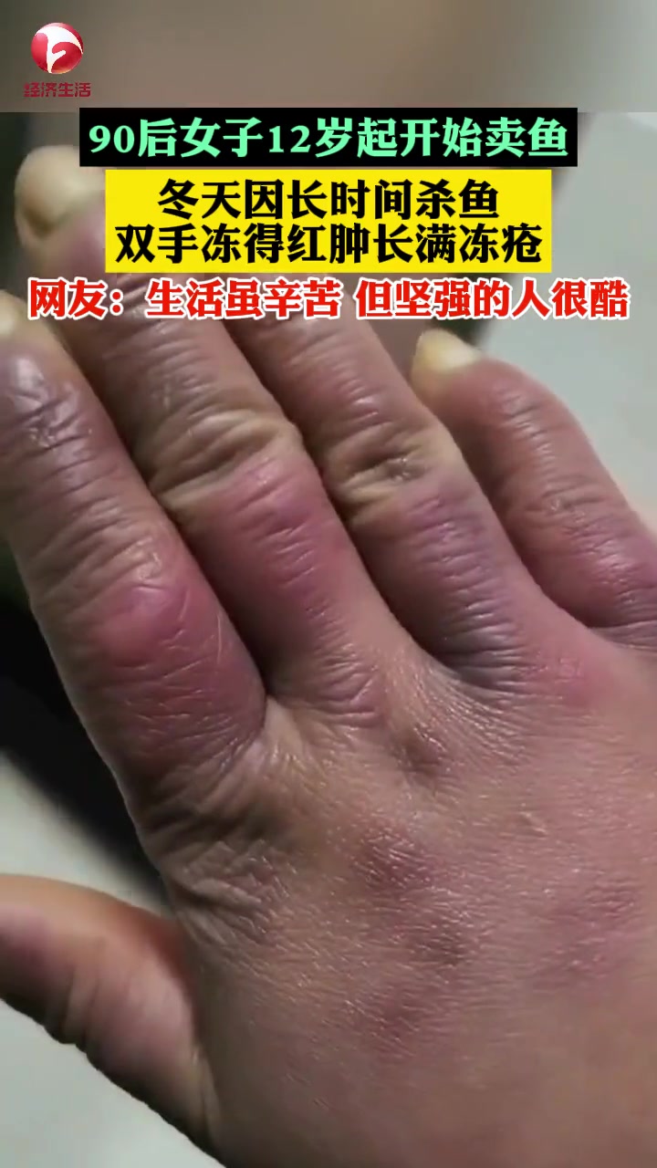 90后女子12岁起就开始卖鱼,工作起来时间不定忙起来甚至要通宵,冬天因长时间杀鱼,双手总是