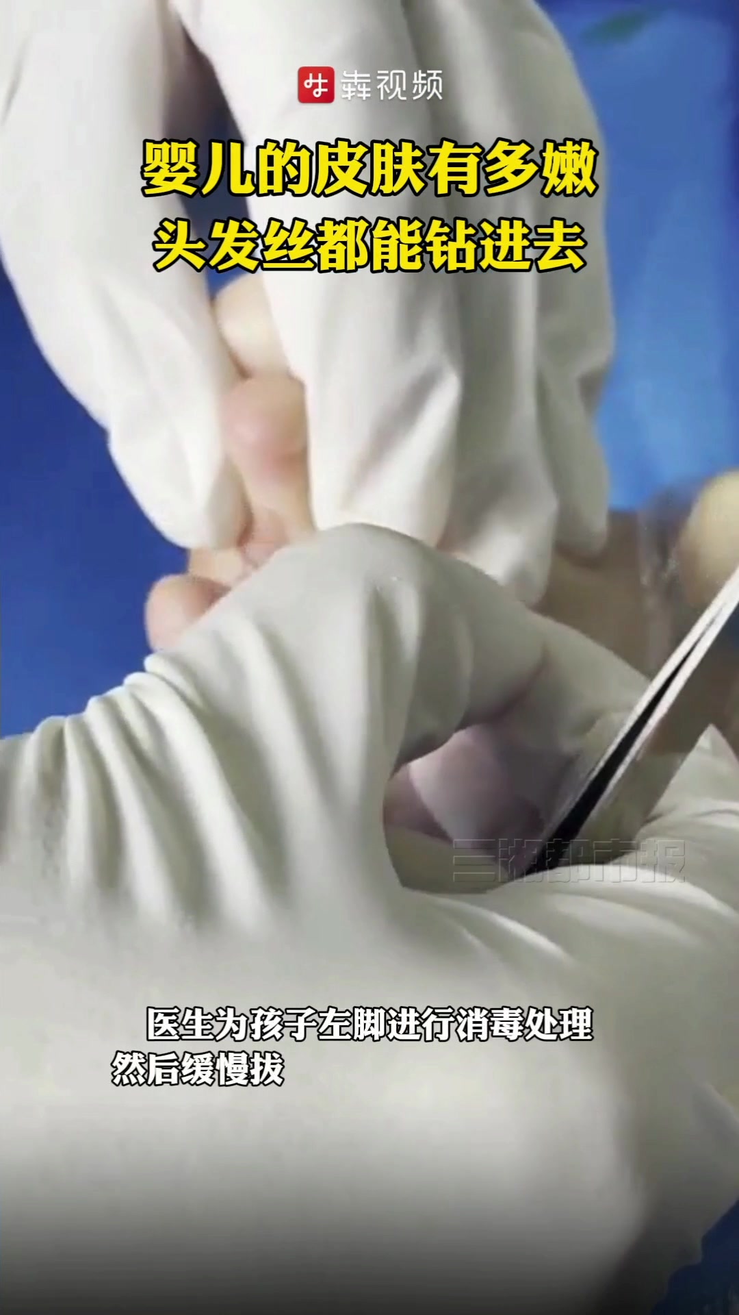 婴儿的皮肤有多嫩?头发丝竟“钻”进女婴脚底
