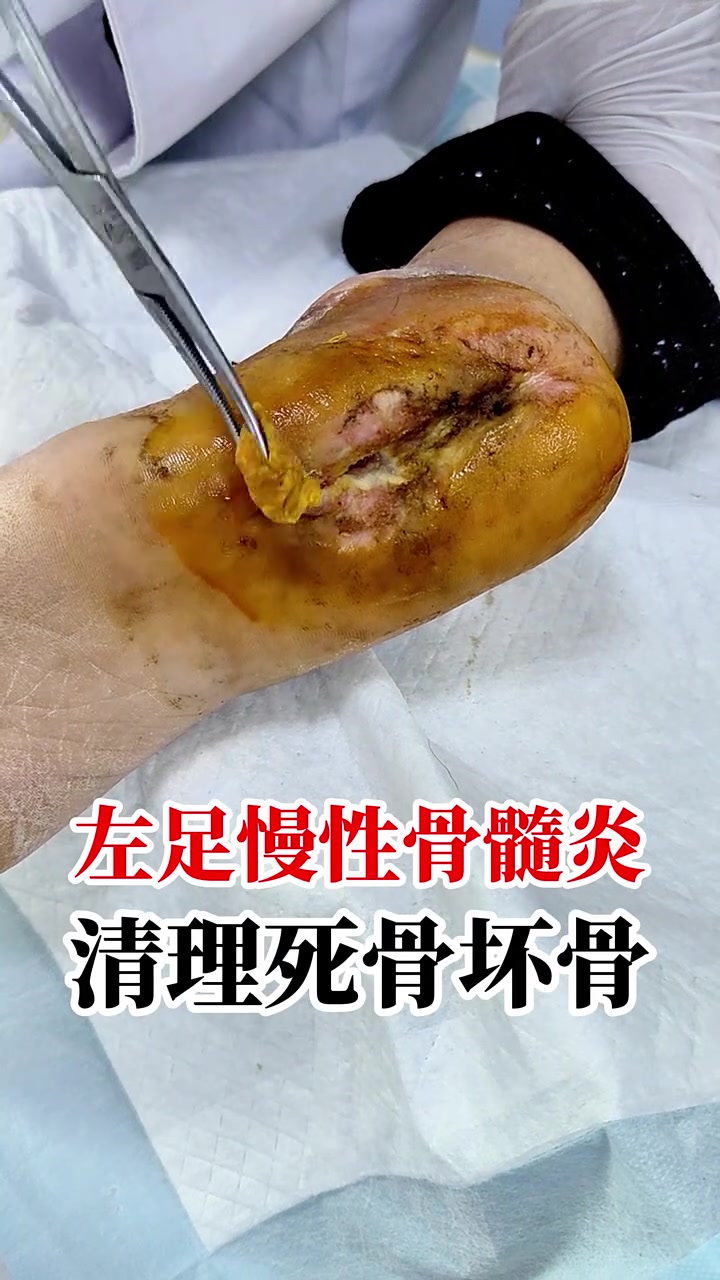第2集|左足慢性骨髓炎,脚底一个洞,清理坏骨头和皮肉