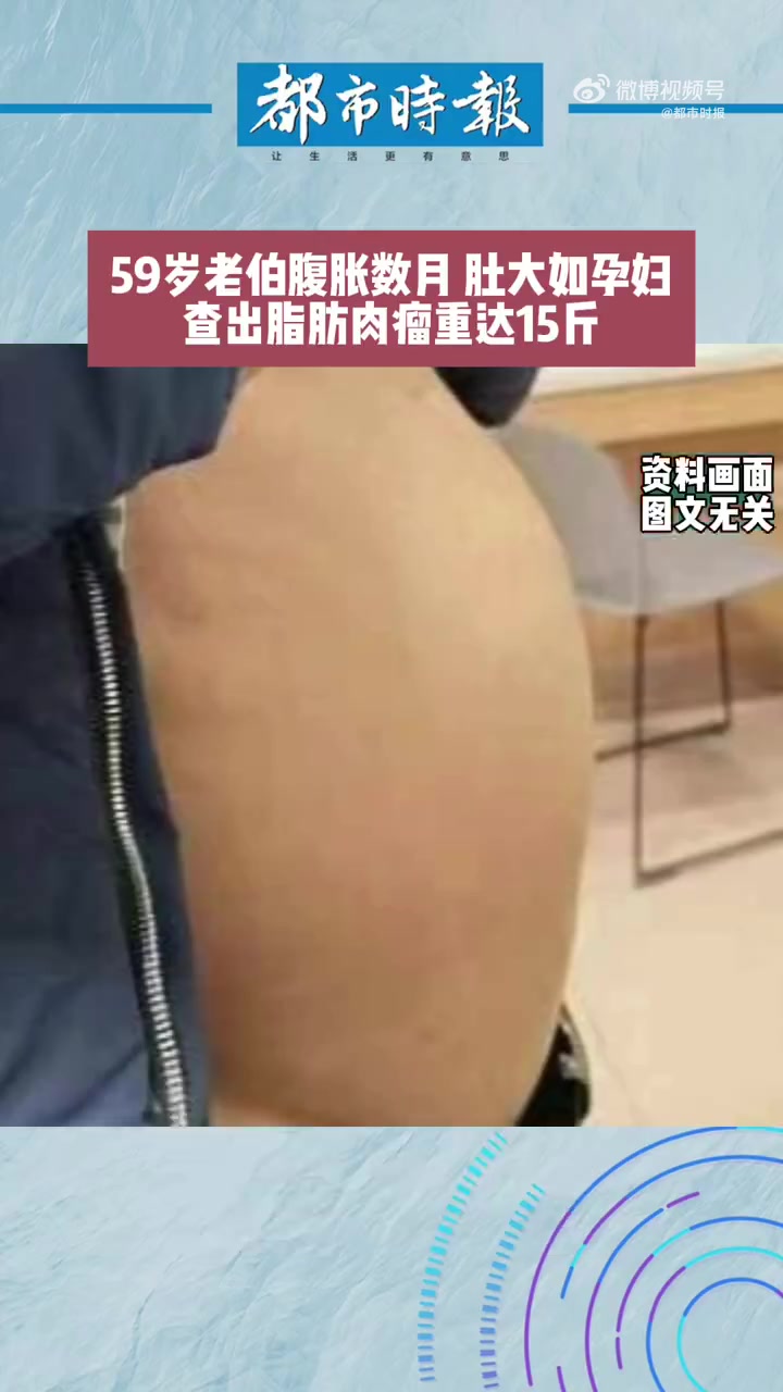 老伯腹胀如孕妇B超一查竟是肿瘤「老人腹胀数月查出脂肪肉瘤重达15斤」近日,浙江杭州,一老伯