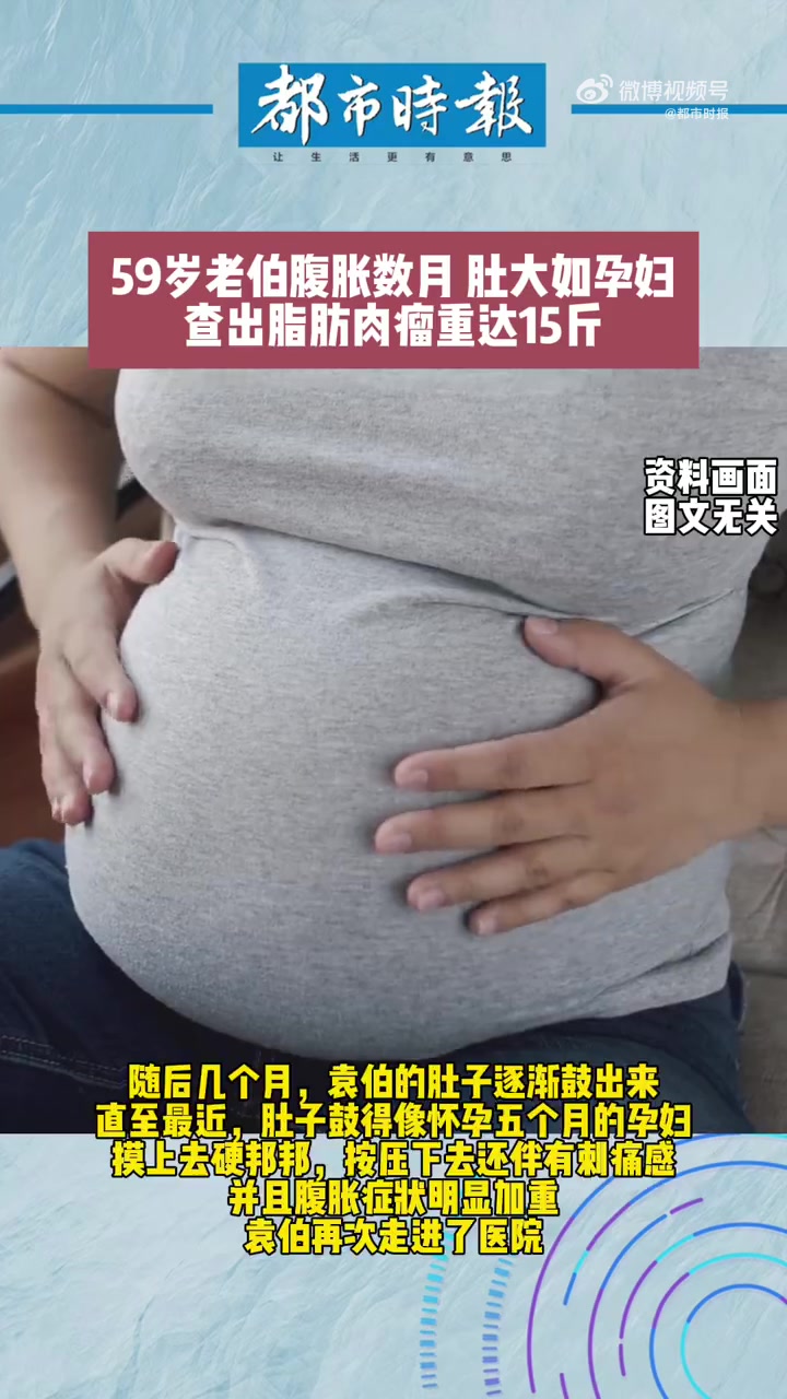 老伯腹胀如孕妇B超一查竟是肿瘤「老人腹胀数月查出脂肪肉瘤重达15斤」近日,浙江杭州,一老伯