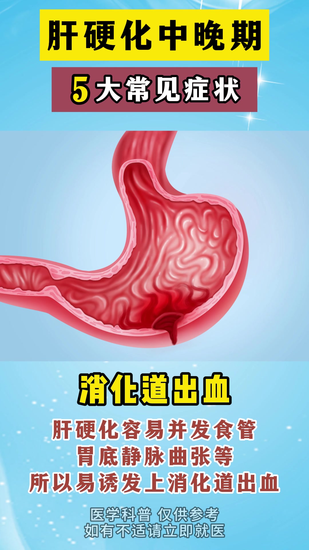 肝硬化中晚期,5大常见症状