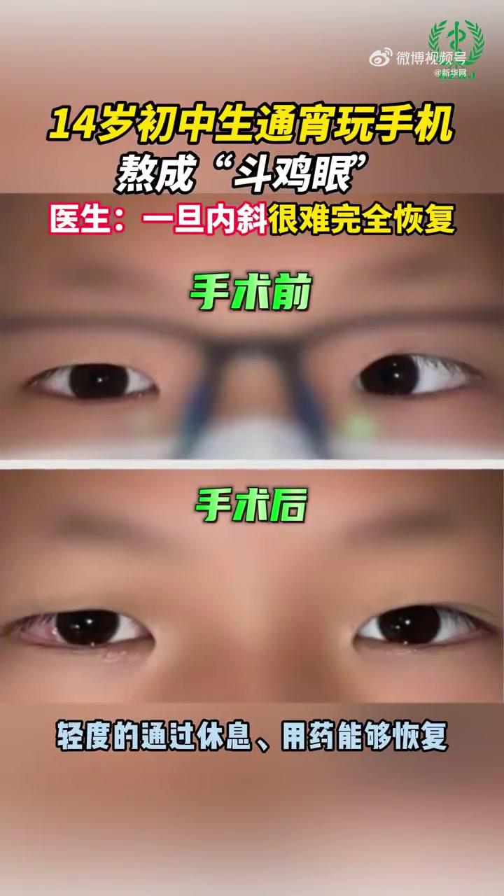 「14岁男孩通宵玩手机熬成斗鸡眼」你每天玩手机多长时间 14岁的男孩儿小李是名初中生,平时