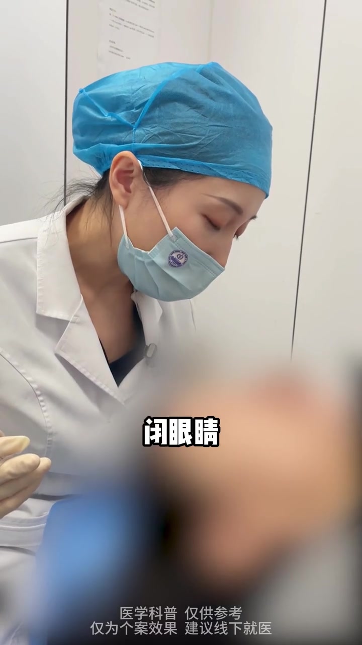 肉毒素注射鱼尾纹一般需要多少单位?鱼尾纹处理方法有讲究 鱼尾纹 除皱针 皱纹 抗衰