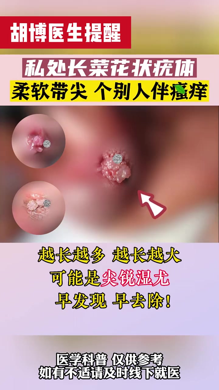 私处的菜花,尖锐湿疣怎么判断