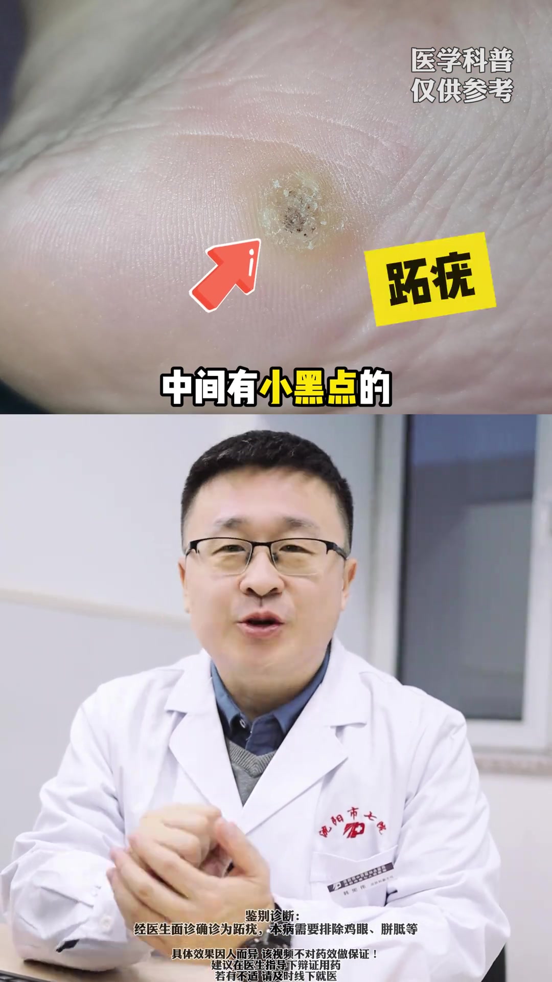 这四种疣体其实并不可怕,医生教你正确处理 丝状疣 寻常疣 跖疣 扁平疣 hpv