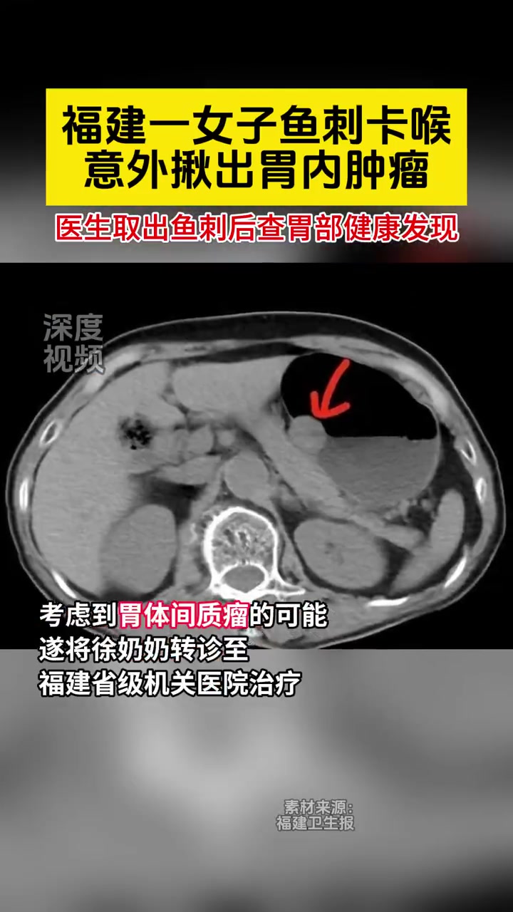 「福建女子鱼刺卡喉意外揪出胃内肿瘤」日前,福建漳州一70岁的徐奶奶不慎被鱼刺卡喉,送医后医