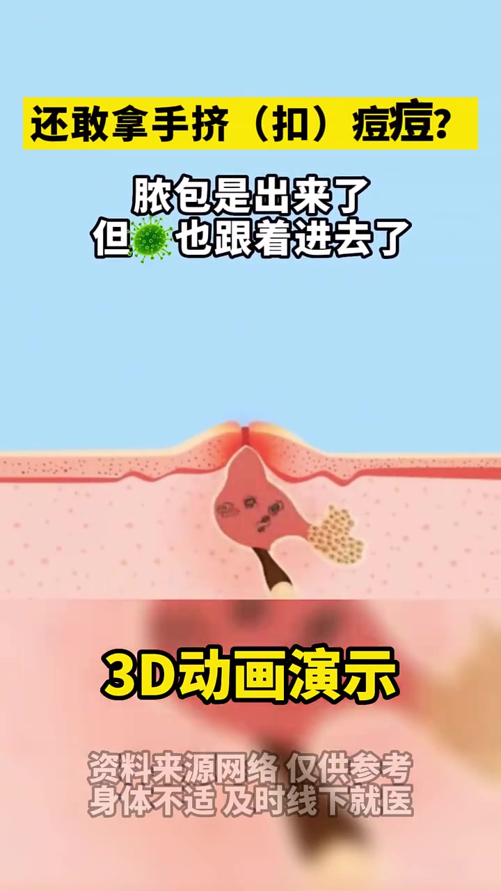 痘痘一般是指痤疮,痤疮是毛囊皮脂腺单位的一种慢性炎症性皮肤病!