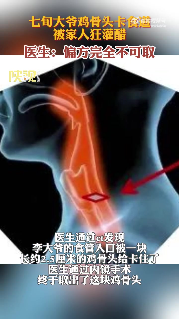「七旬大爷鸡骨头卡喉被家人狂灌醋」近日,陕西西安。70岁李大爷和家人聚餐时,突然感到咽喉部