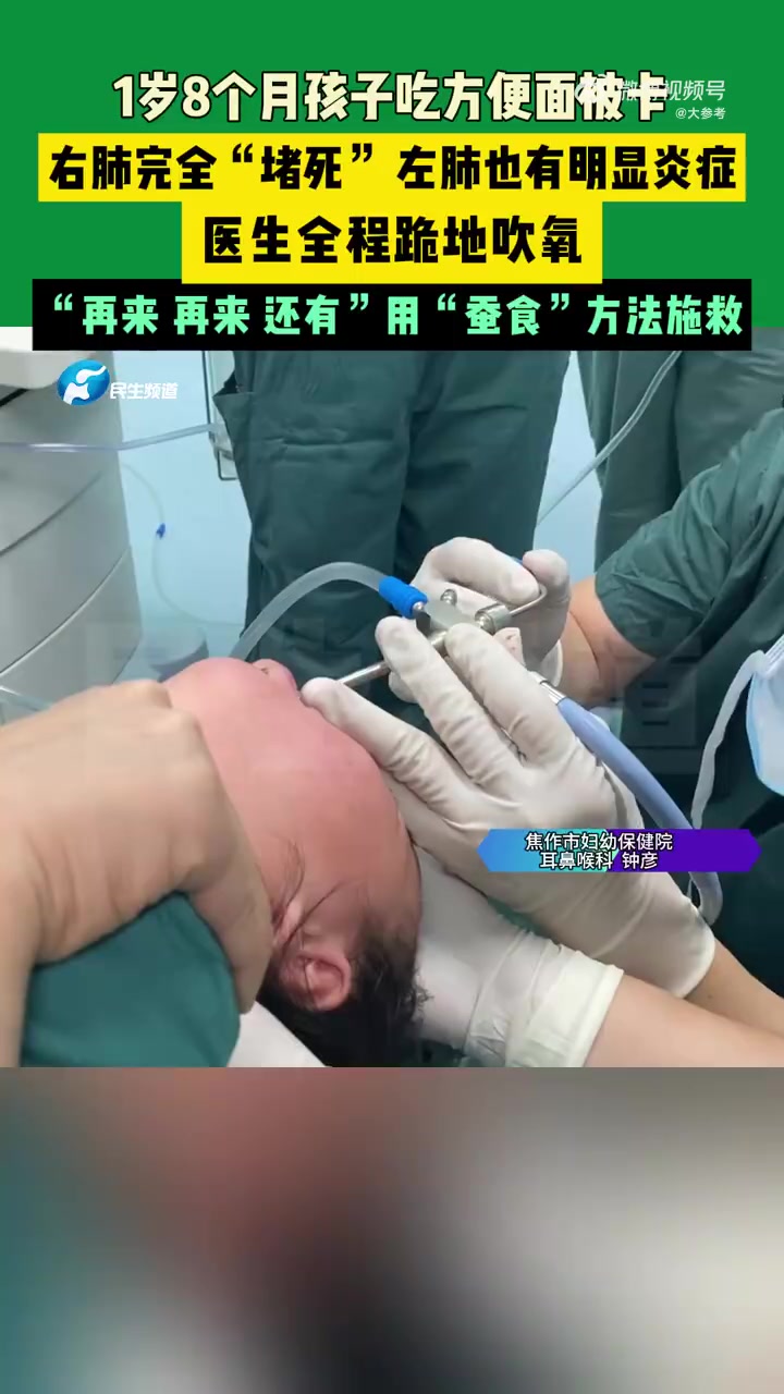 「1岁宝宝误食方便面被卡右肺完全堵死」3月12日(发布),河南焦作一名1岁8个月的宝宝误食