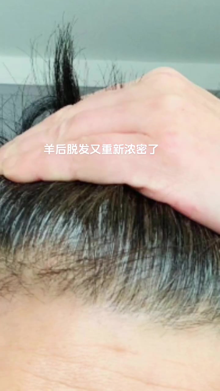 羊后脱发你有吗?脱发太严重了,满地一堆堆的头发,人走到哪里头发就掉到哪里,以至于头皮都露出