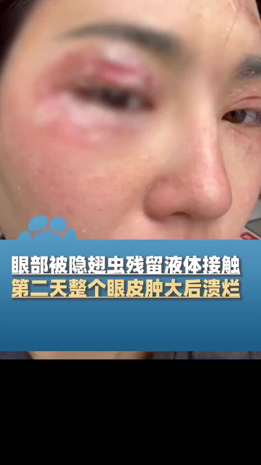 会飞的硫酸?警惕这种毒虫,已进入活跃期!