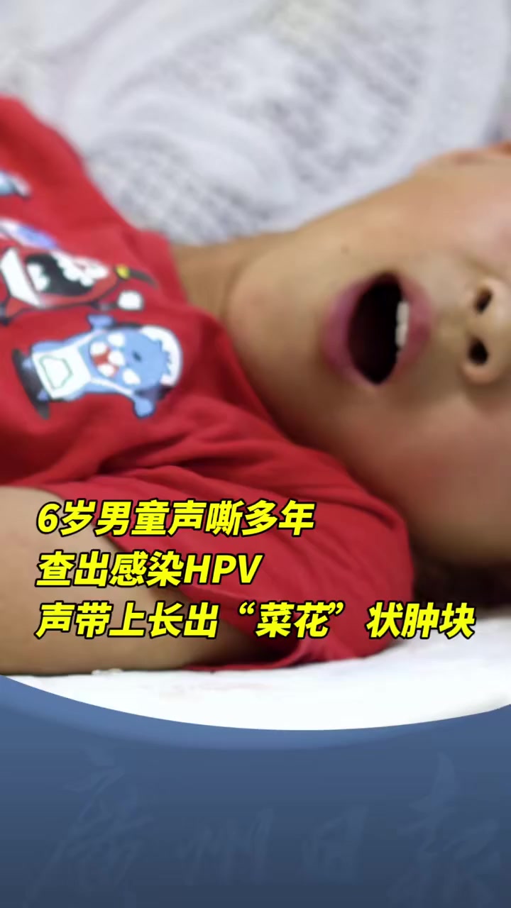 6岁男童声嘶多年 查出感染 HPV 声带上长出“菜花”状肿块 深圳 健康