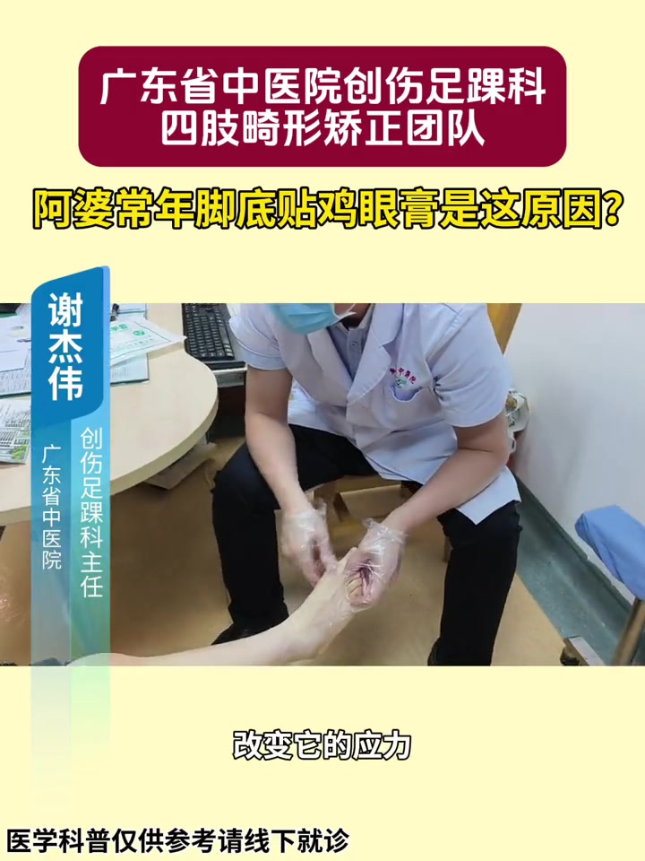 足底鸡眼疼痛几十年,忍无可忍来就诊。鸡眼 拇外翻