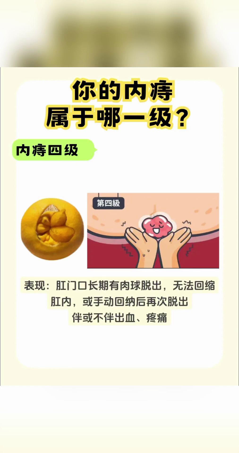 痔疮长什么样?赶紧来对照看看你是哪一类?