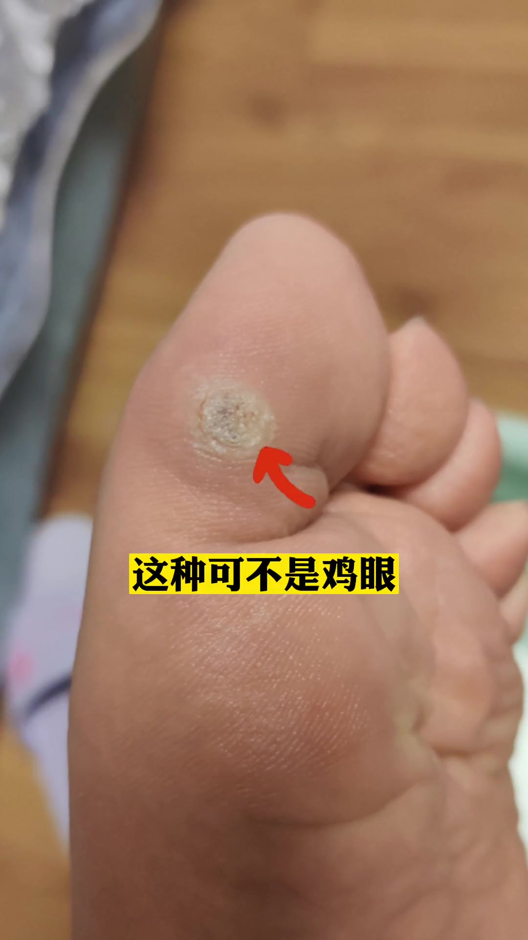 脚底板长小疙瘩,摸起来有点粗糙,这可不是鸡眼,千万别乱治!
