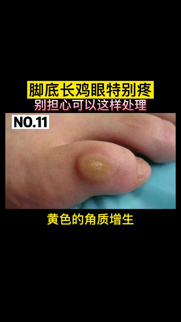 脚底长鸡眼特别疼,应该如何办