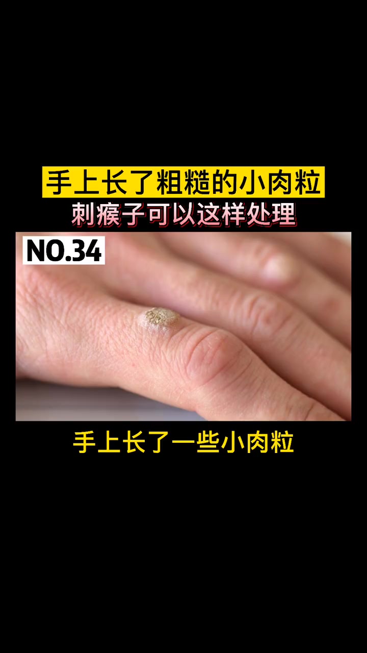 手上长小肉粒,剪了还继续长,刺瘊子应该如何办
