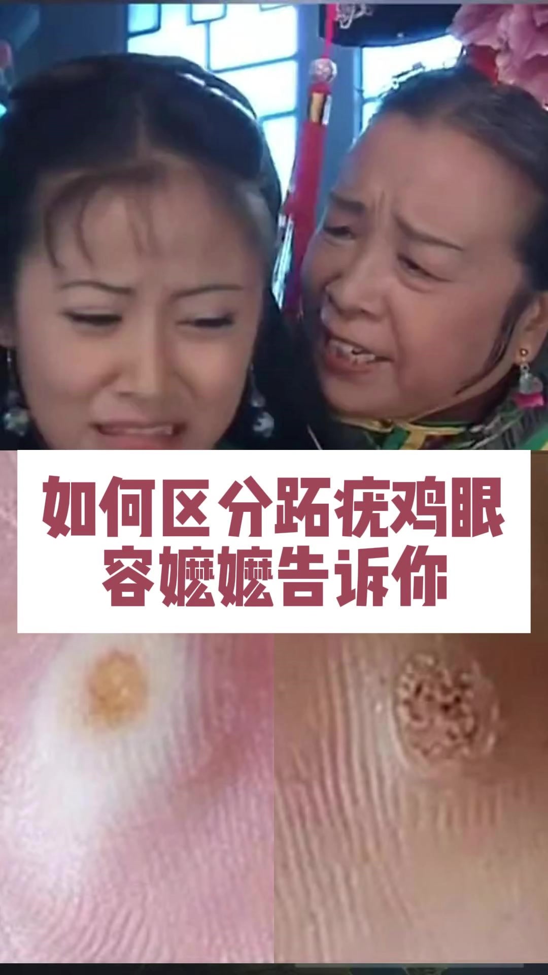 如何区分跖疣鸡眼 容嬷嬷告诉你