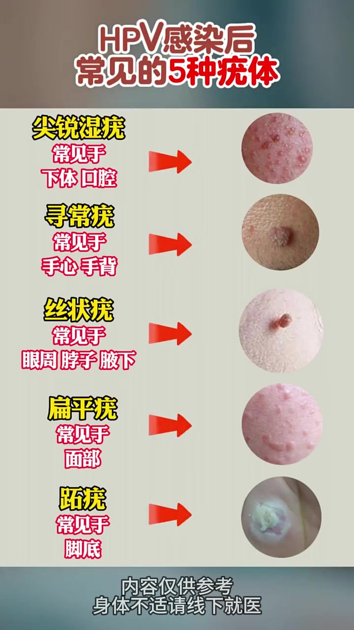 HPV感染后常见的五种疣体 健康科普