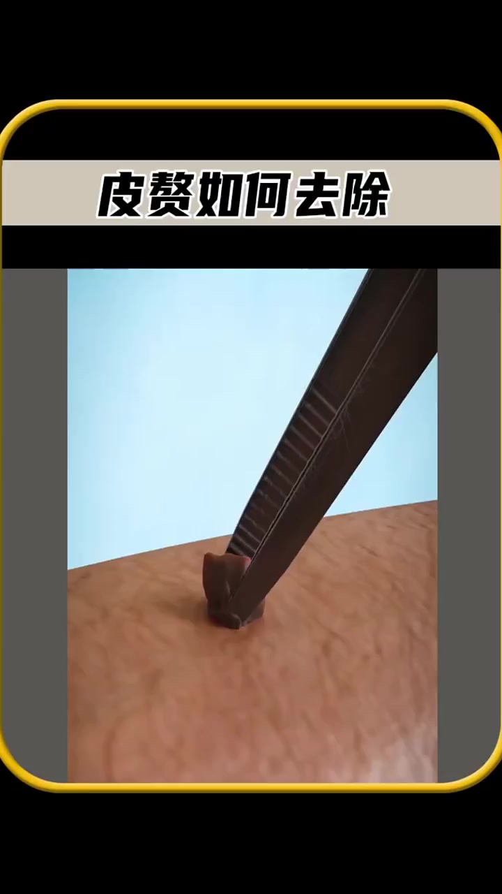 如果身上长颗皮赘,你知道我们应该怎么做吗