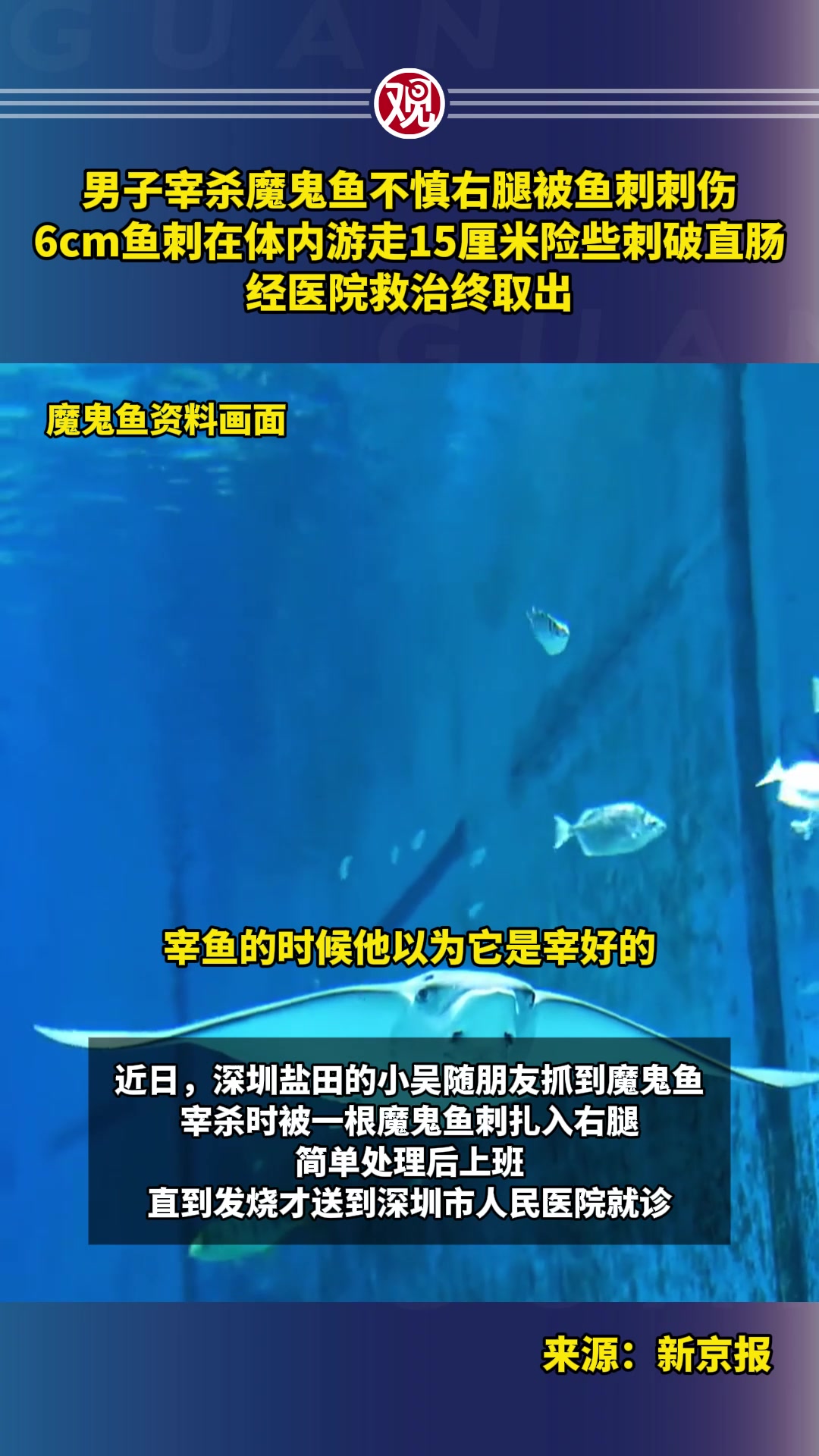 男子宰杀魔鬼鱼不慎右腿被鱼刺刺伤,6cm鱼刺在体内游走15厘米险些刺破直肠,经医院救治终取