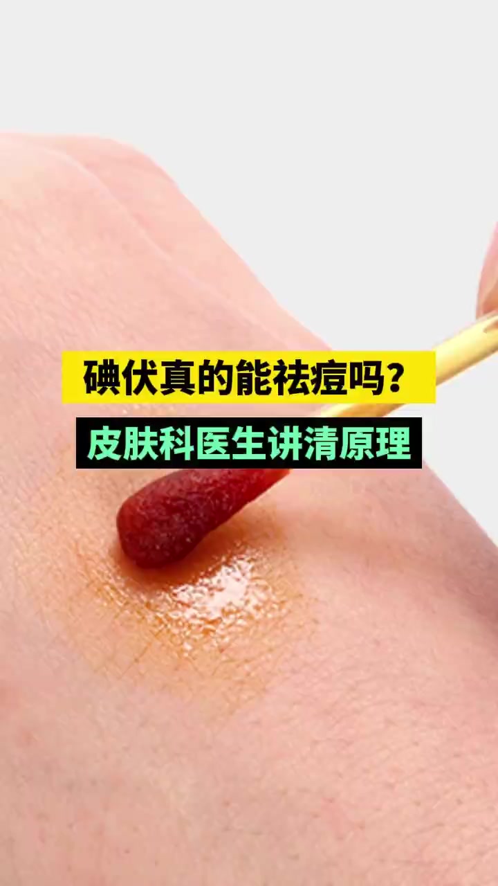 引热议,碘伏真的可以祛痘吗?北京大学第一医院皮肤性病科主任医师杨淑霞表示,从痘痘的发病机理