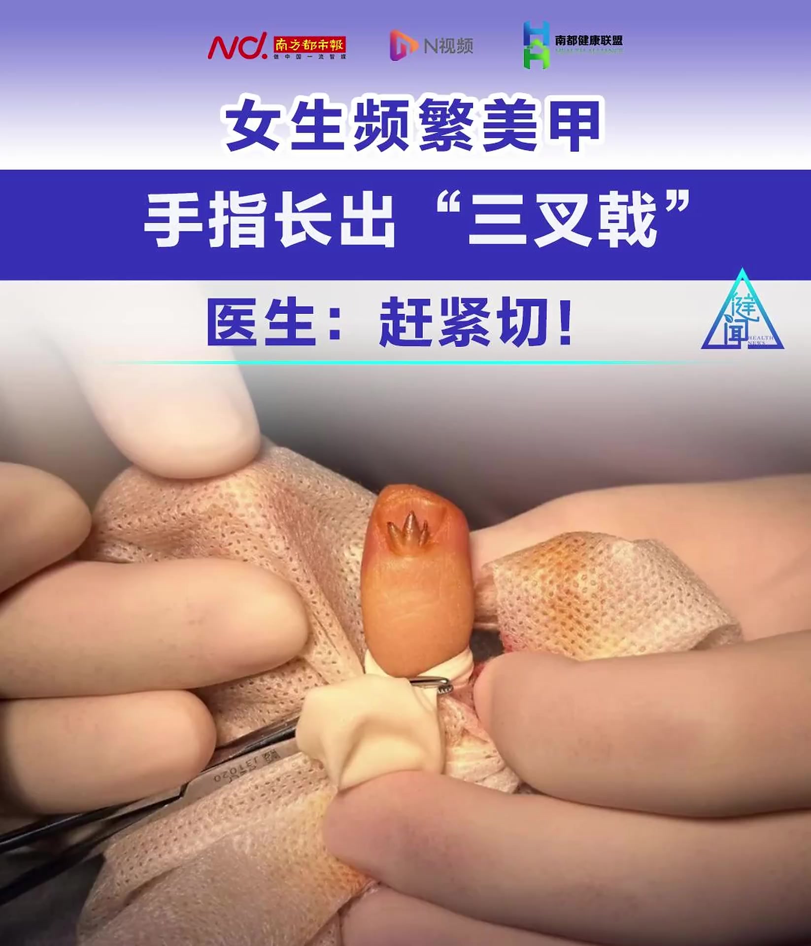 女生频繁美甲,手指长出“三叉戟”,医生:赶紧切!