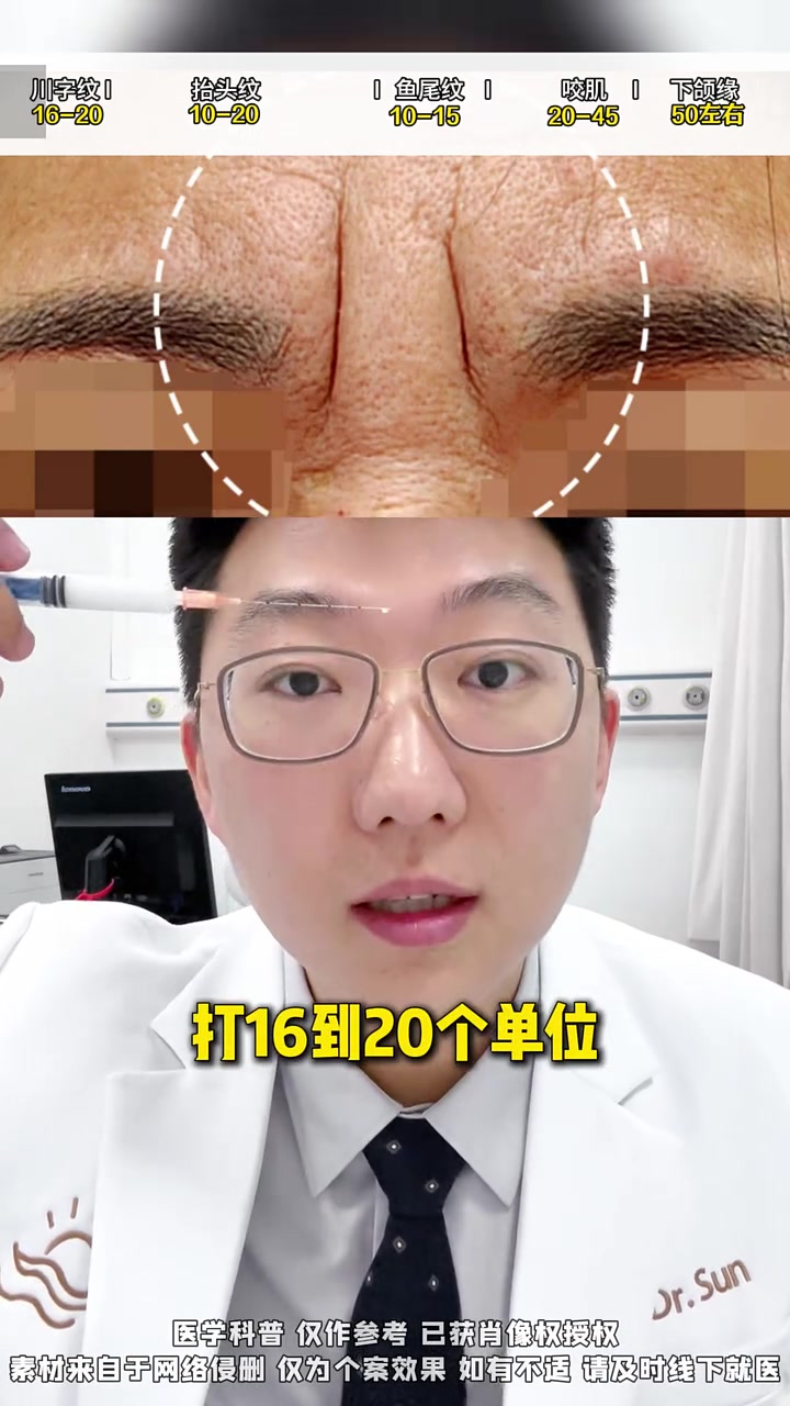 全脸肉毒素怎么打最省钱?玻尿酸  整形医生孙艺谋 中轴线提升